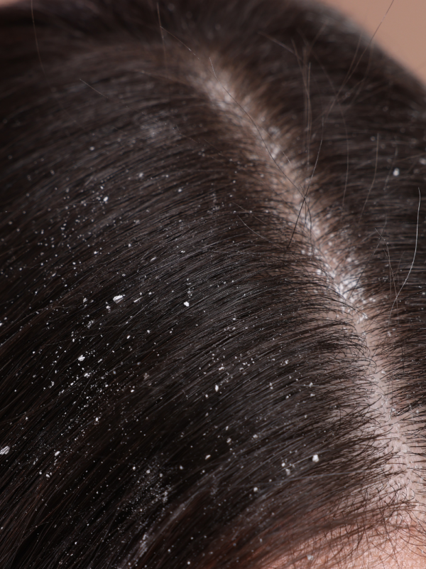 Schuppen loswerden: 7 Tipps, die wirklich helfen!