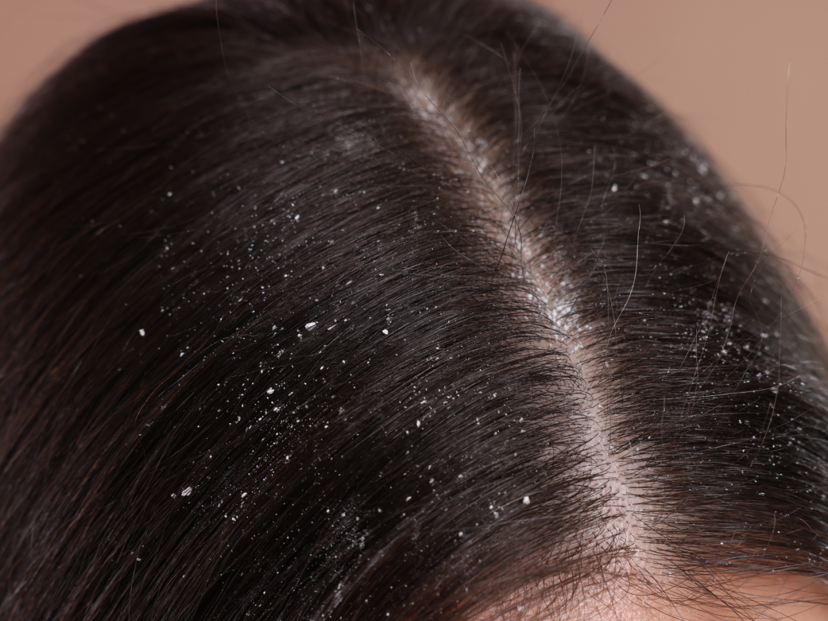 Nahaufnahme von Steitel mit Schuppen übersäht.