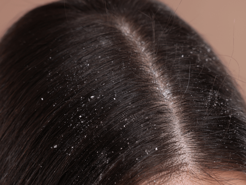 Nahaufnahme von Steitel mit Schuppen übersäht.