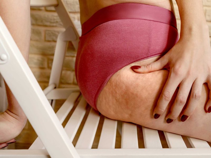 Frau sitzt auf Stuhl. Nahaufnahme von Cellulite am Bein.
