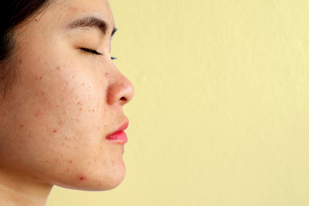 L&ouml;cher in der Haut: Ursachen & Hilfe f&uuml;r einen ebenm&auml;&szlig;igen Teint