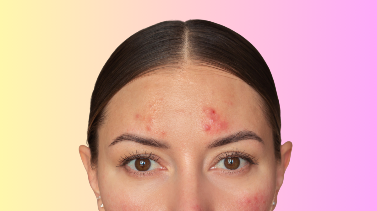 Frau vor einem bunten Hintergrund, die rote Pusteln im Gesicht hat