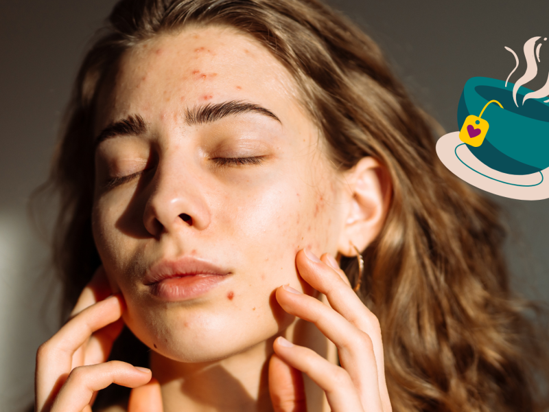 Frau mit kleinen und großen Pickeln im Gesicht und daneben eine Tasse Tee.
