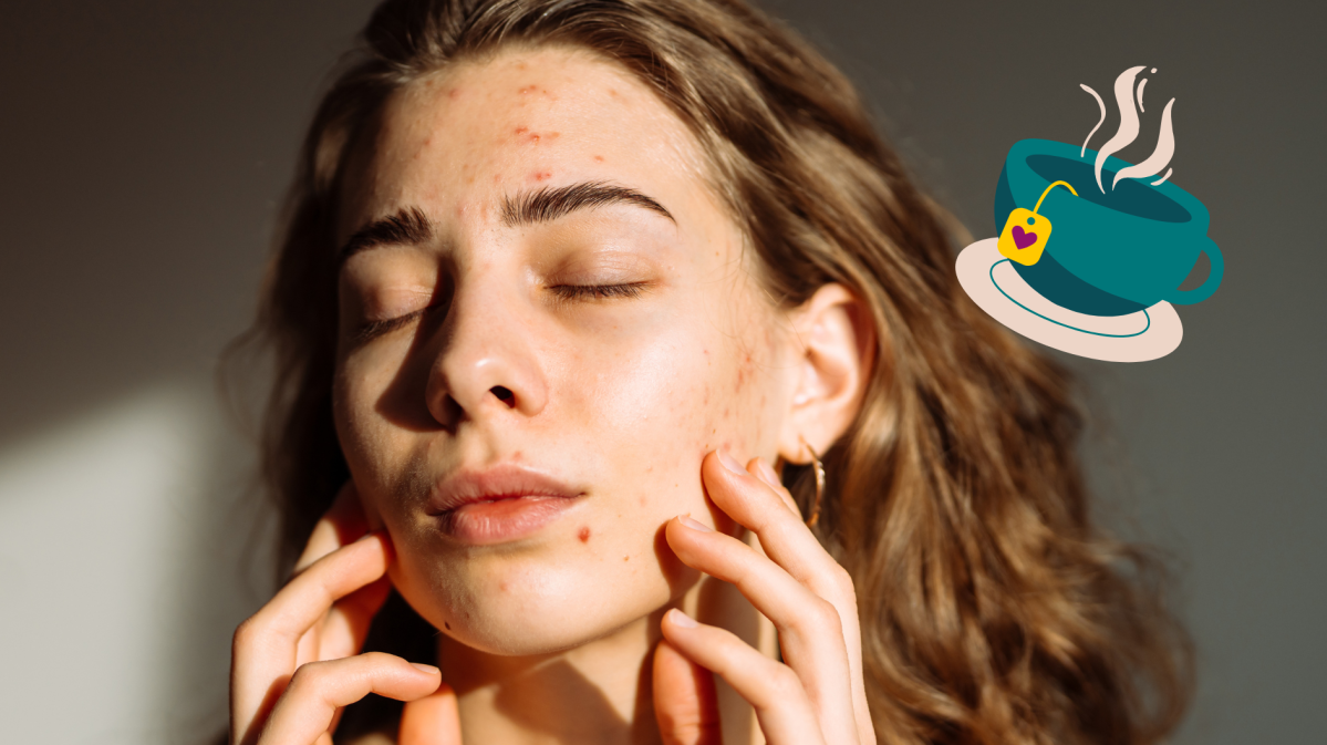 Frau mit kleinen und großen Pickeln im Gesicht und daneben eine Tasse Tee.
