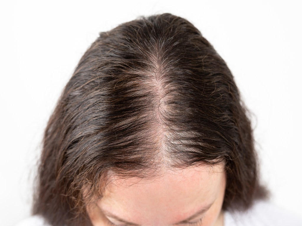 Androgenetischer Haarausfall