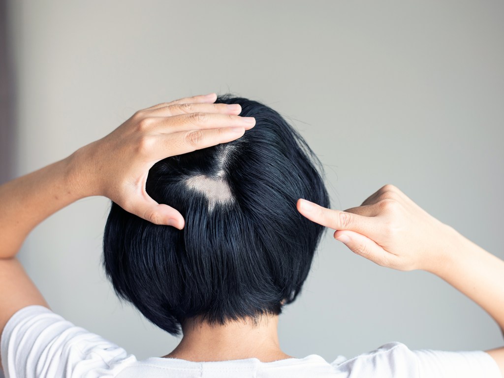 Kreisrunder Haarausfall