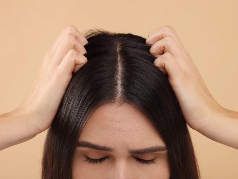 Junge Frau mit dunklen Haaren kratzt sich an ihrer Kopfhaut, weil diese trocken ist.