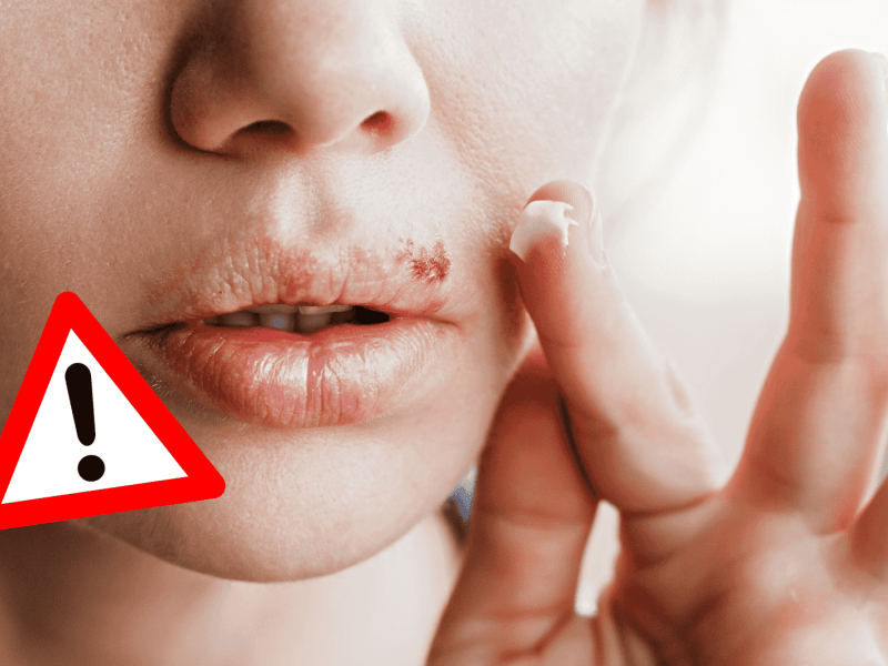 Frau hat Lippenherpes und gibt Creme darauf.